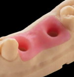 Rășină pentru mască gingivală